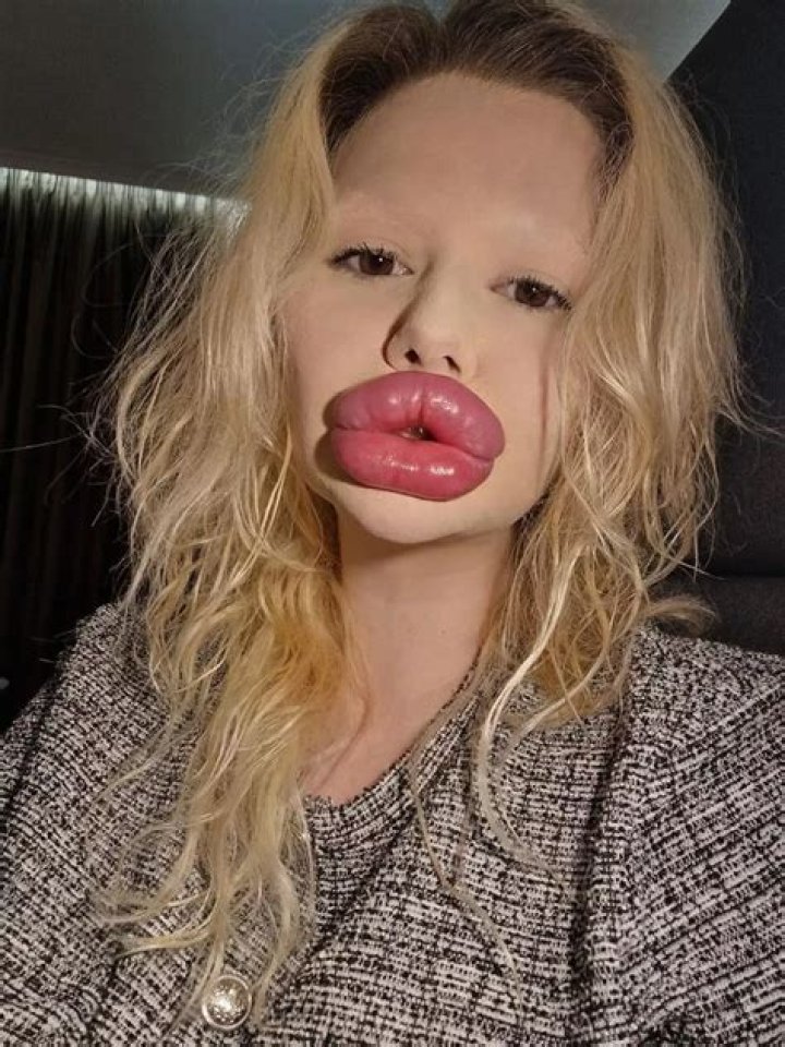 Biggest lips in the world? 22-year-old Barbie is on her way