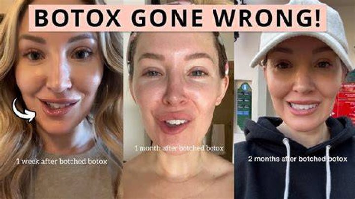 I got Botox for 20 years — here's what happens when you stop