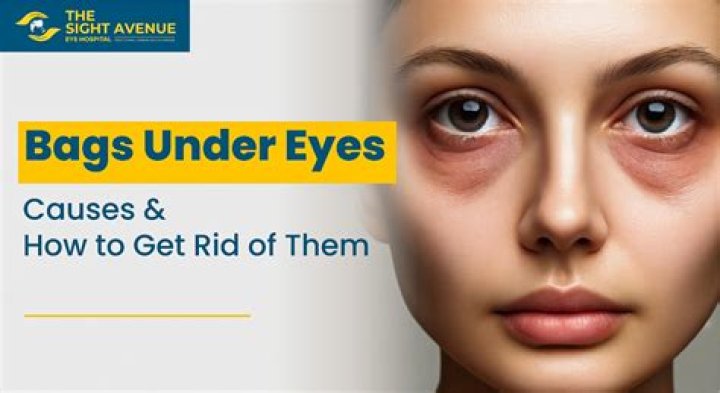 I paid $4K to remove my eye bags — people say I didn’t need to