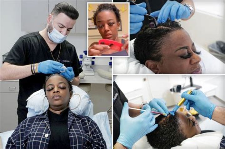 Stem cell therapy after another hair debacle