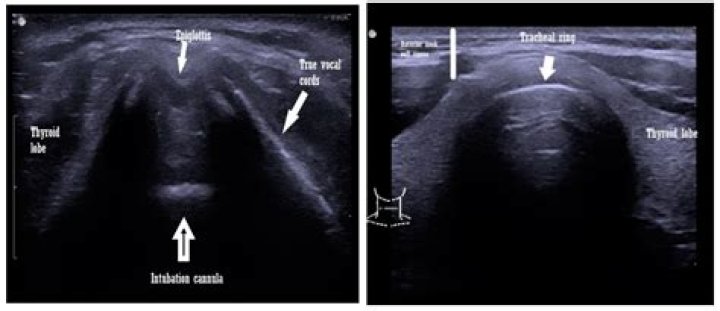 Ultrasound shows parasites wriggling about in man's stomach